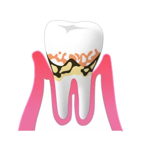 軽度歯周炎のイラスト